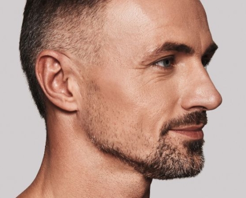 Rimodellamento jawline con ultrasuoni microfocalizzati ecoguidati