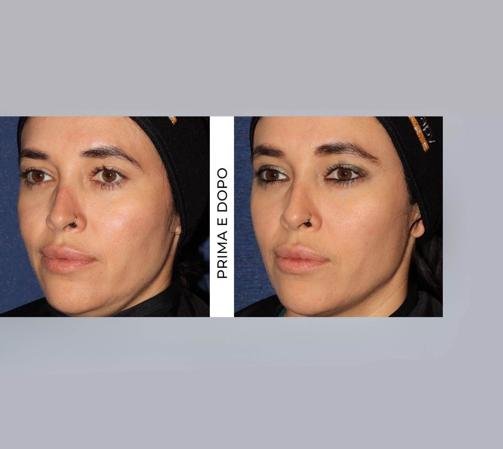 Prima e dopo il trattamento Ultherapy PRIME